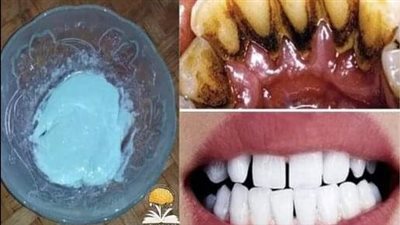 أفضل وصفة على الاطلاق للتخلص من الجير وتكلّس الأسنان