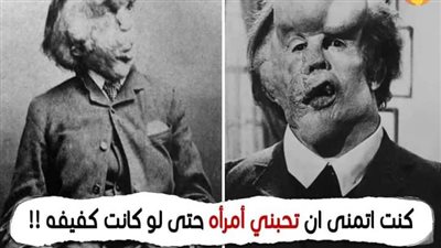 الطفل الڠريب 🤔الملقب (برجل الفيل)كنت اتمنى ان تحبني أمرأه حتى لو كانت كفيفه !!